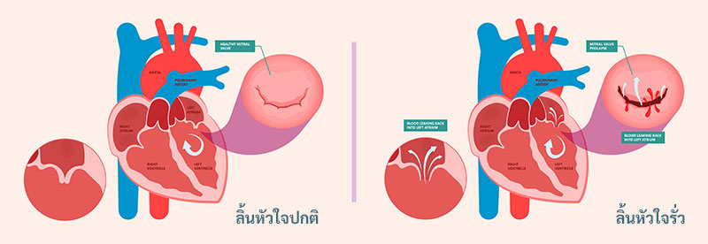 โรคลิ้นหัวใจรั่ว